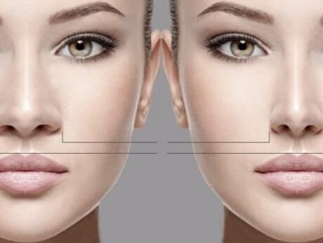 Veja como reduzir a abertura das narinas com a cirurgia no nariz