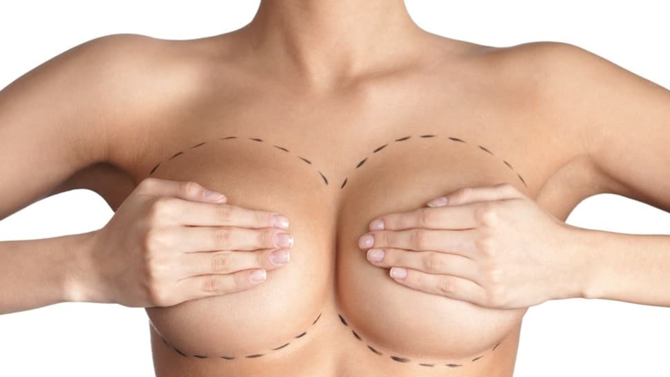 Implante de Silicone