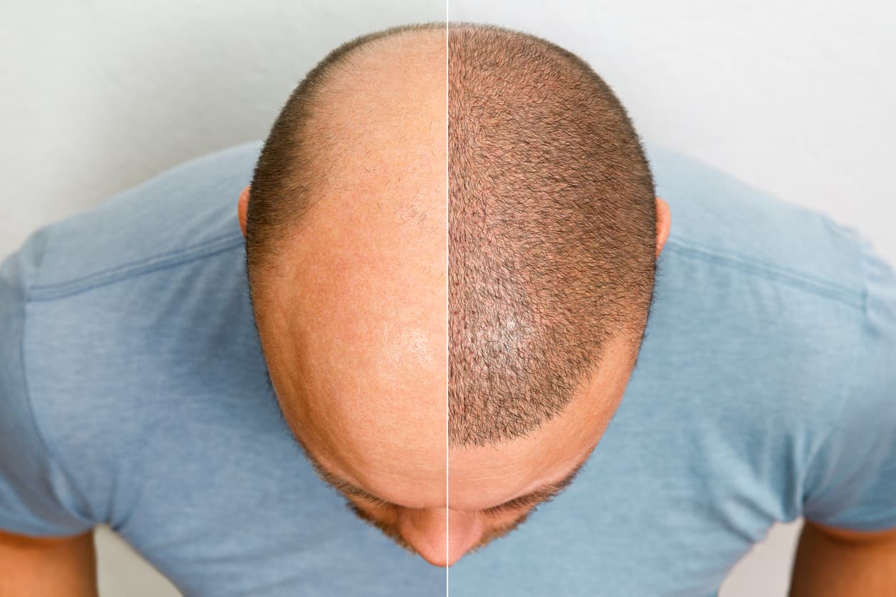 Antes e depois da aplicação da técnica FUE.