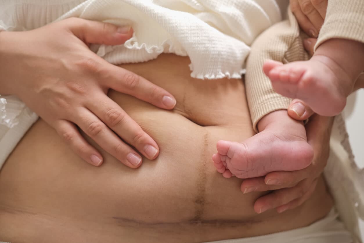 Close de uma barriga pós-parto com cicatriz de cesárea