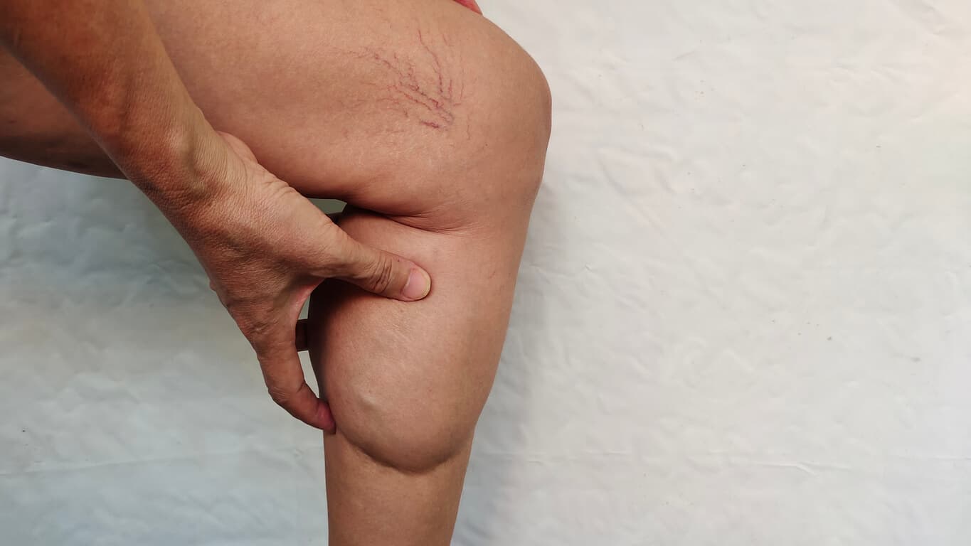 Pessoa segura a parte inferior da perna mostrando acúmulo de gordura e vasos aparentes, ilustrando sintomas visuais do lipedema nas pernas.