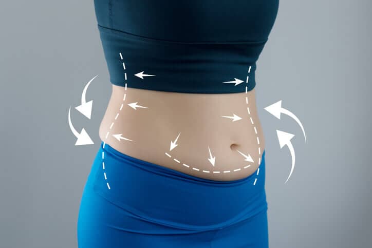 Conheça mais sobre a abdominoplastia 360