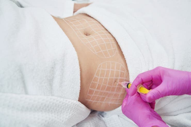 abdominoplastia para flacidez