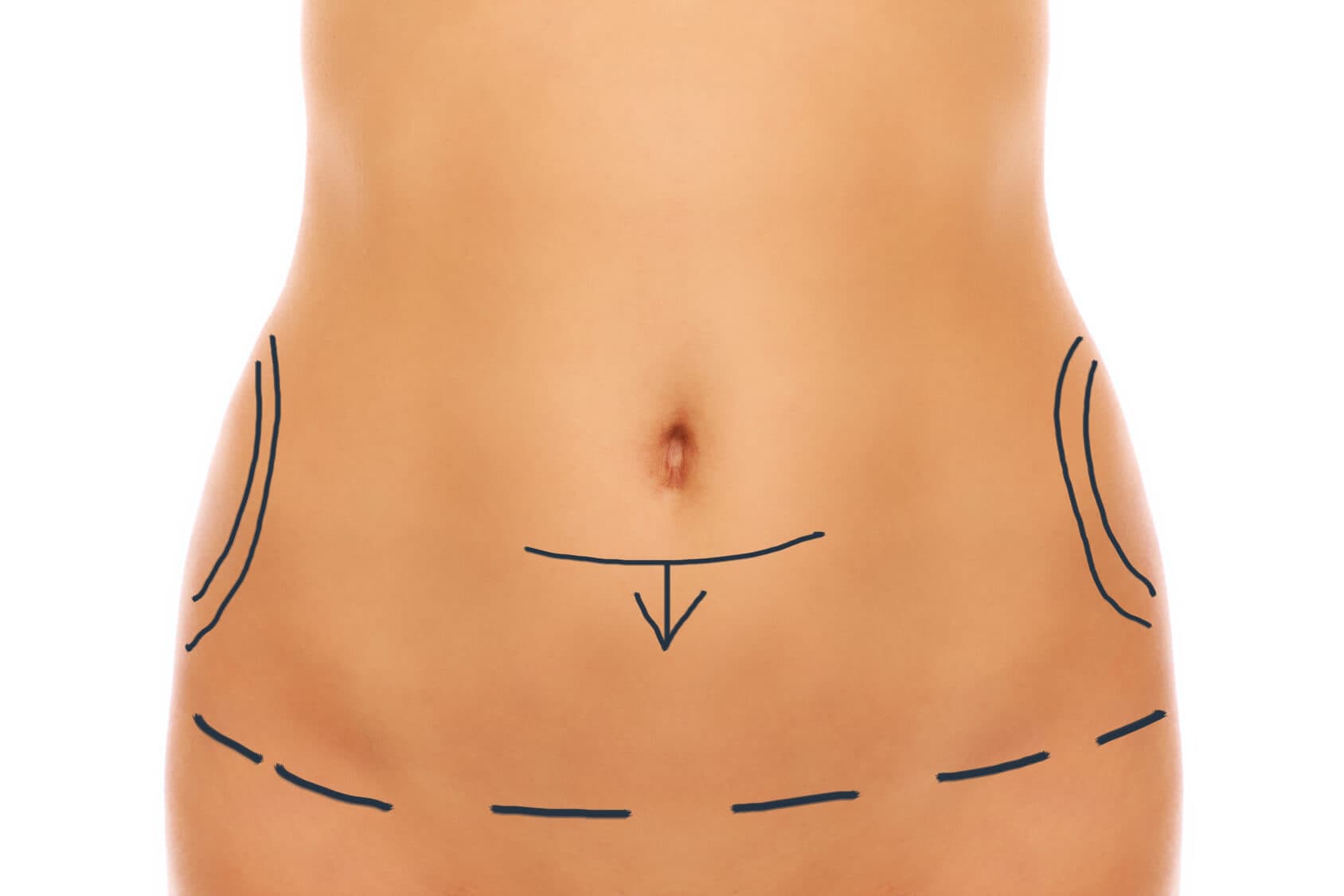Saiba tudo sobre a mini abdominoplastia