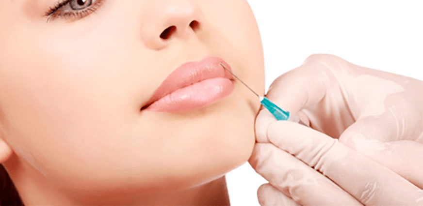 mulher fazendo preenchimento labial com ácido hialurônico