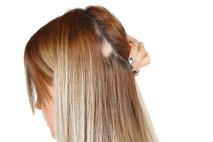saiba as causas e tratamentos para a alopecia areata