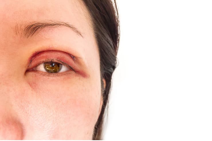 conheça alguns cuidados relevante após a realização da blefaroplastia