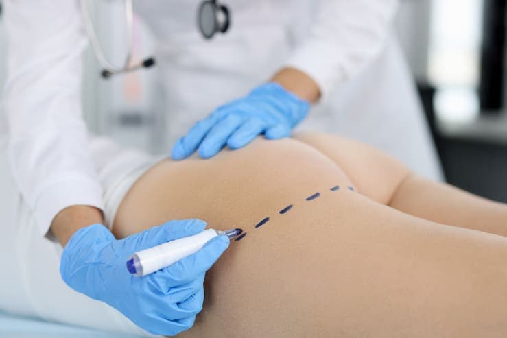 procedimento sendo realizado nos gluteos