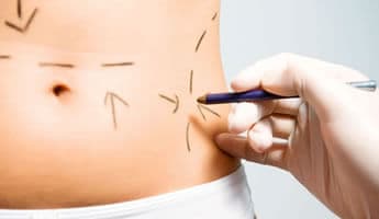 carboxiterapia para estrias