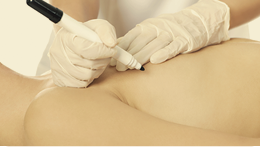 Mamoplastia Redutora: tire todas as suas dúvidas