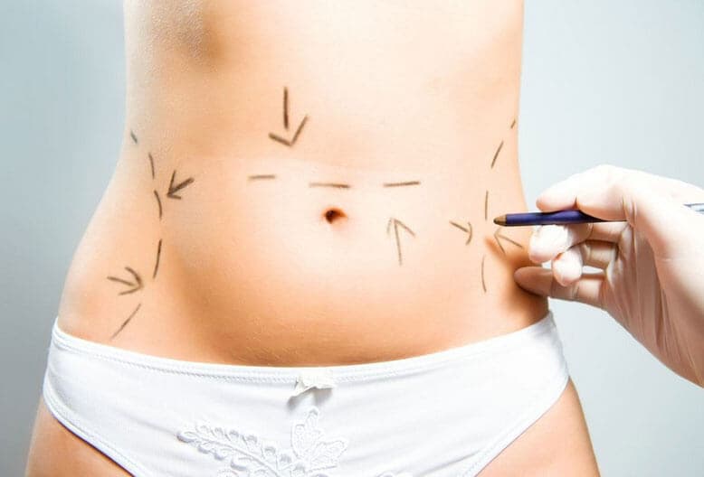 Mulher com as marcações na barriga antes de uma cirurgia plástica