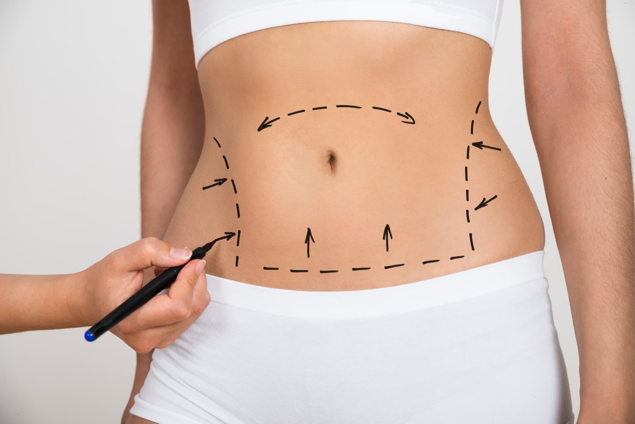 como funciona lipoescultura
