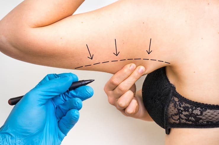 Conheça, neste artigo, a dermolipectomia: a cirurgia plástica para remoção do excesso de pele