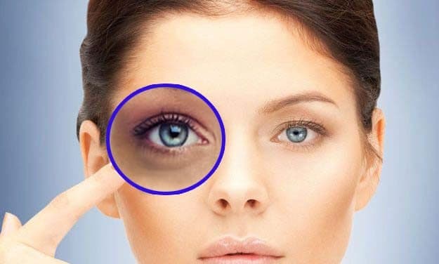 bolsas nos olhos