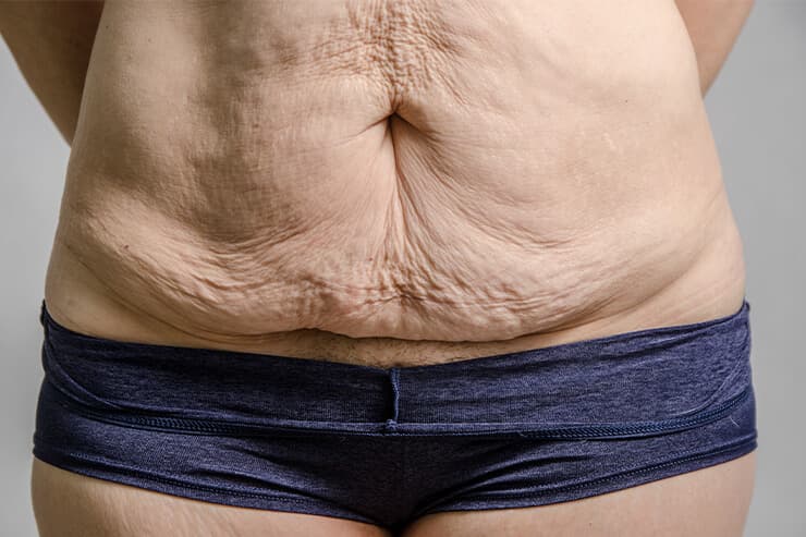 como proceder após emagrecimento pós-bariátrica