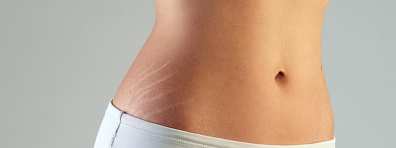 Sabia que existe tatuagem para cobrir estrias