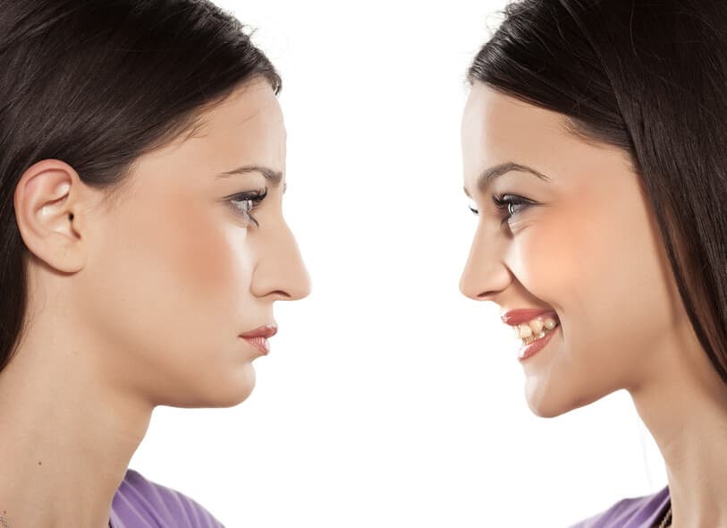Especial de Rinoplastia