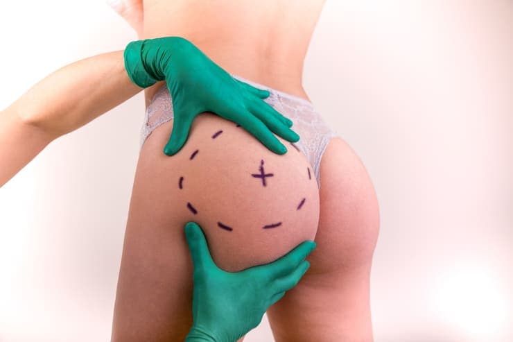 Dicas para ver antes da gluteoplastia
