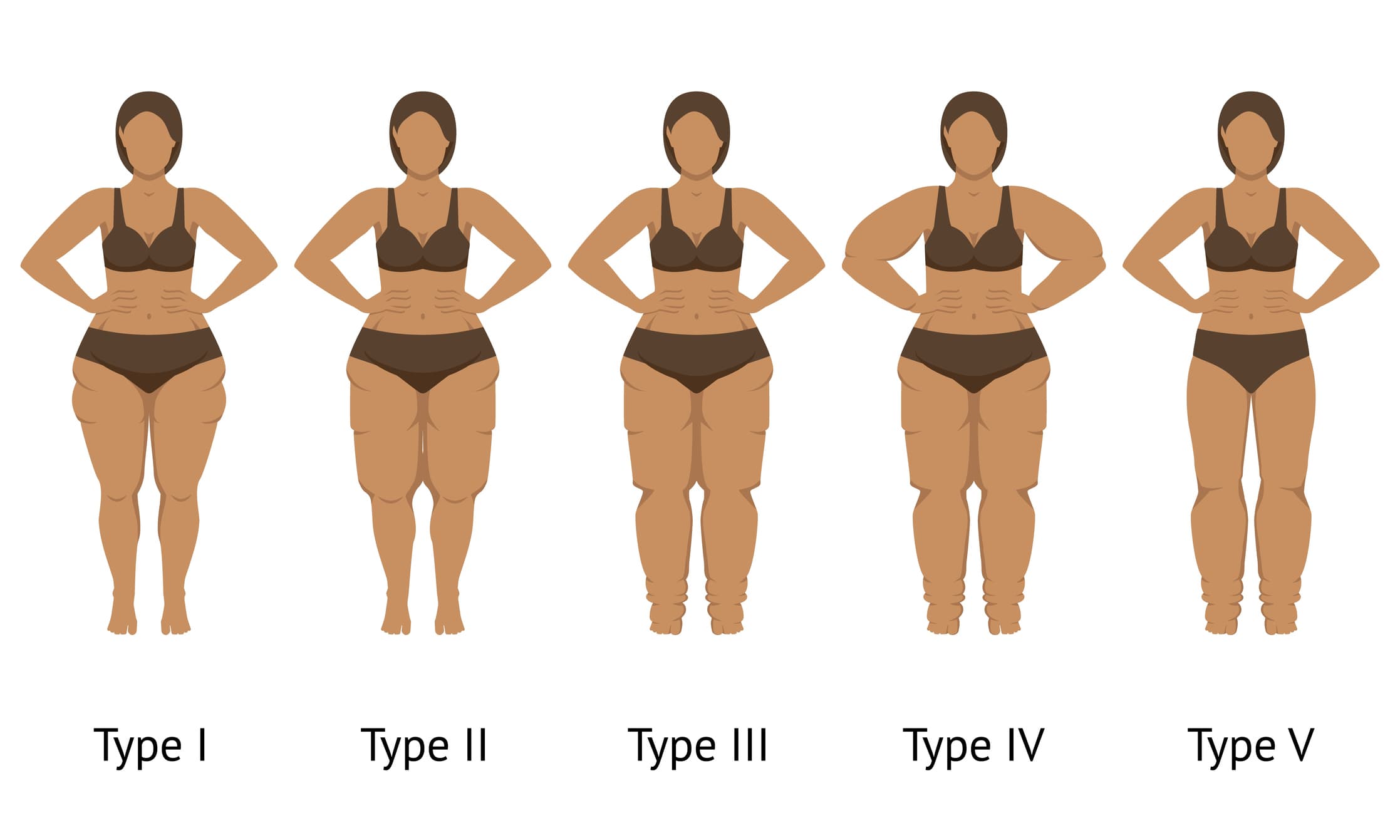Lipedema