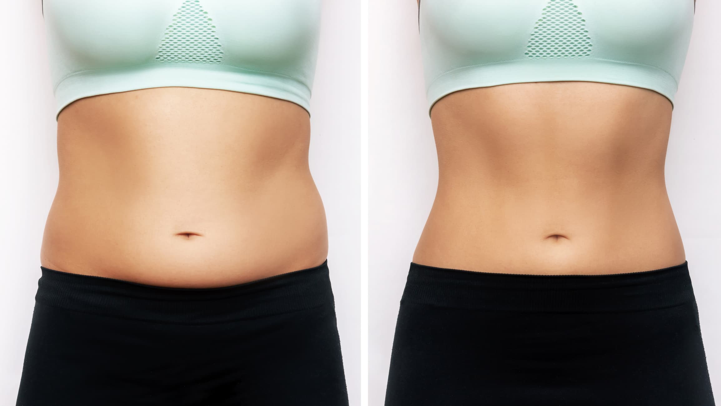 A lipo HD auxilia no contorno dos músculos. Confira nosso post e saiba como ele funciona e as diferenças para a lipoaspiração!