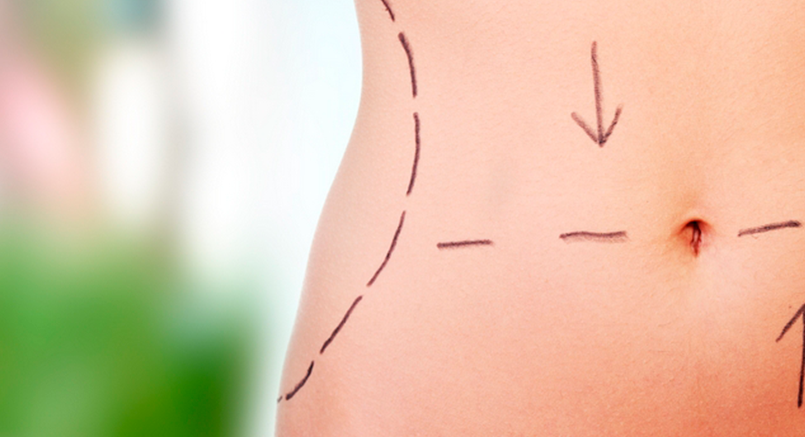 Saiba como manter os resultados da sua Lipoaspiração