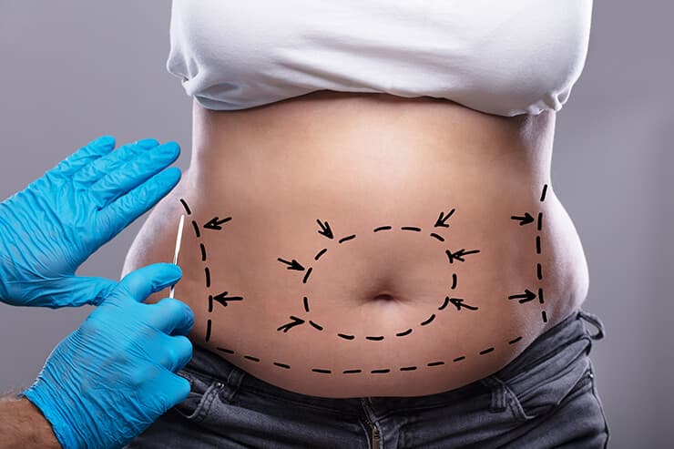 saiba se é uma boa ideia fazer uma lipoaspiração após bariátrica