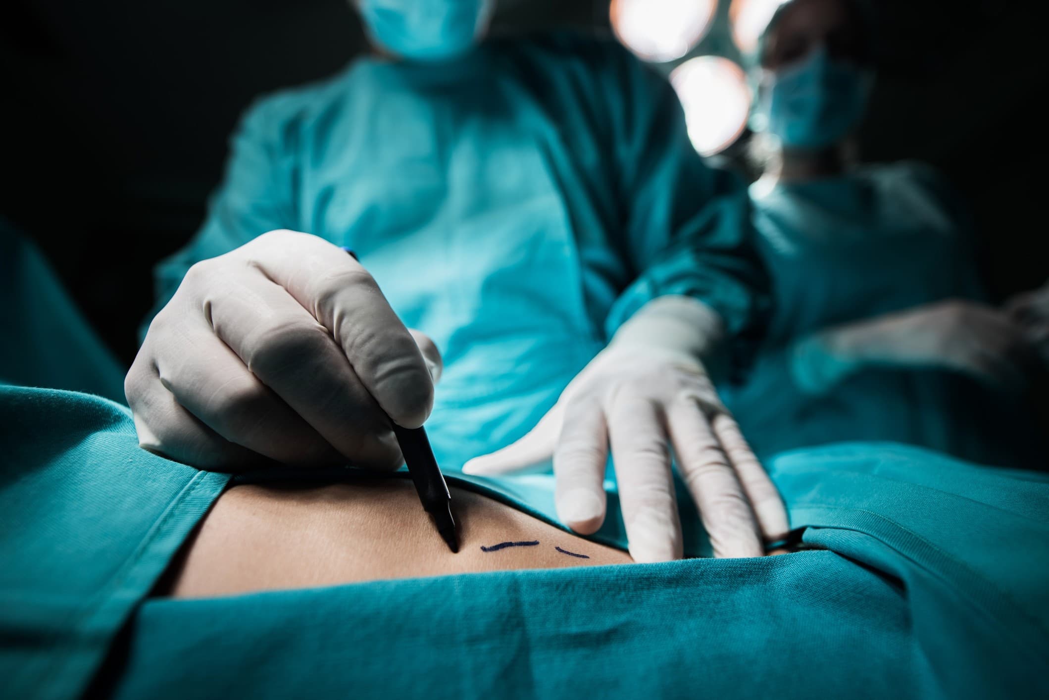 lipoaspiração