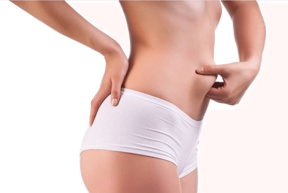Mulher com excesso de gordura na barriga. Mini Lipo e Lipoaspiração