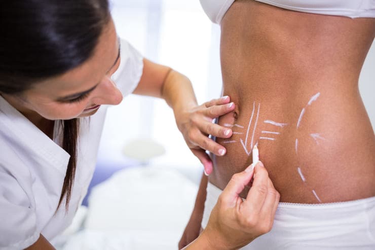 Entenda sobre a cirurgia de abdominoplastia