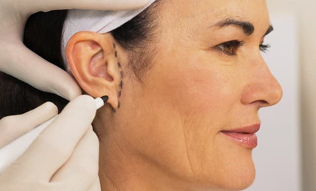 A otoplastia em adultos