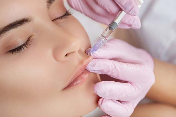 O que preciso saber sobre o preenchimento labial?
