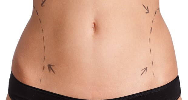 Lipoaspiração Quadril