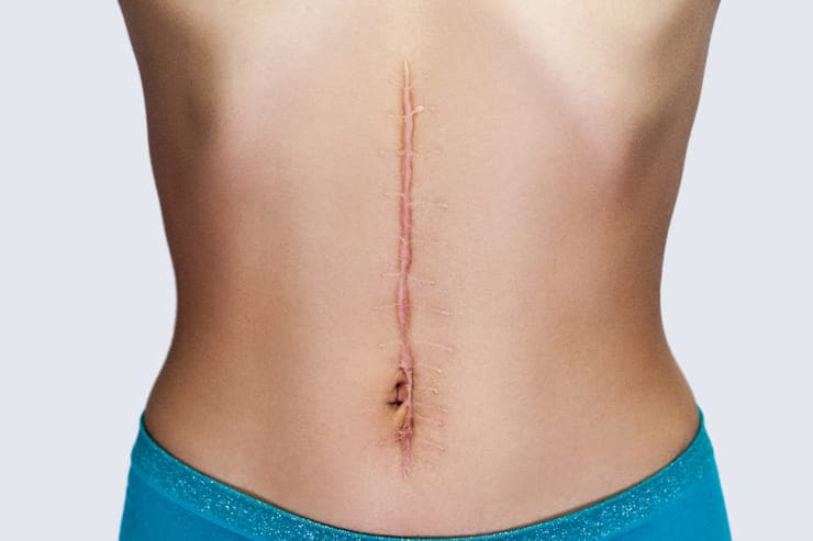 Como lidar com queloide pós cirurgia