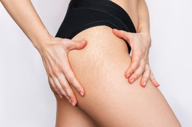 mulher com tatuagem para cobrir estrias