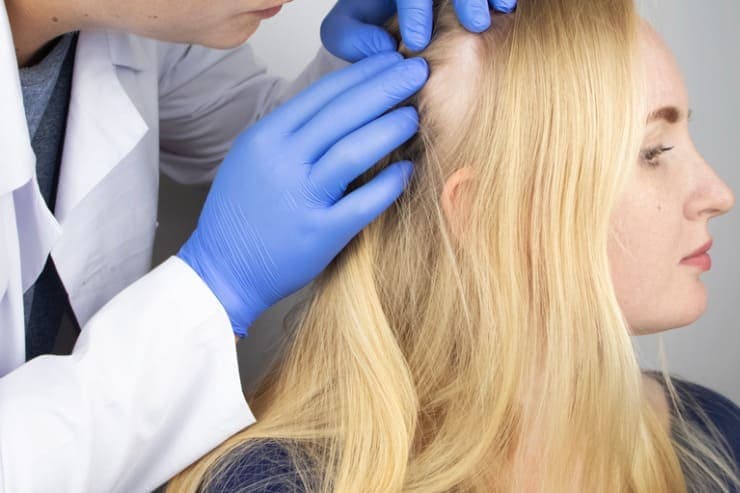 tipos de alopecia e tratamentos