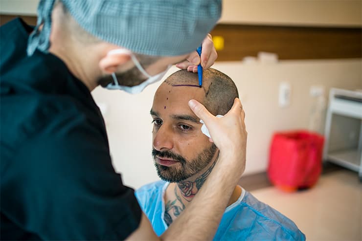 como saber quando é indicado o procedimento de transplante capilar