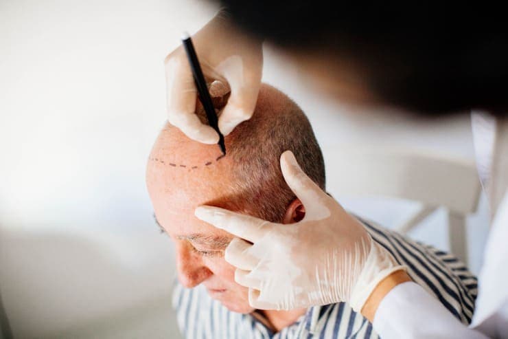 Dicas para ver antes do transplante capilar