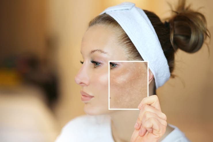tratamentos para melasma