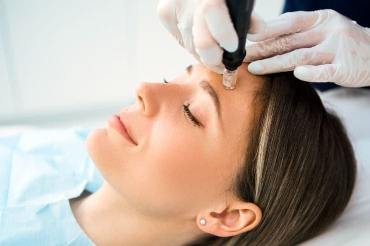 tratamento laser co2 para acne