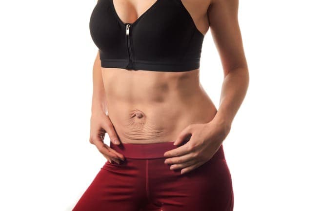 mulher com diástase abdominal