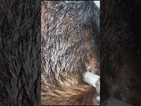 Dermal Needling para Alopecia