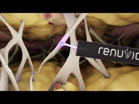 Renuvion Cosmetic Technology Animation