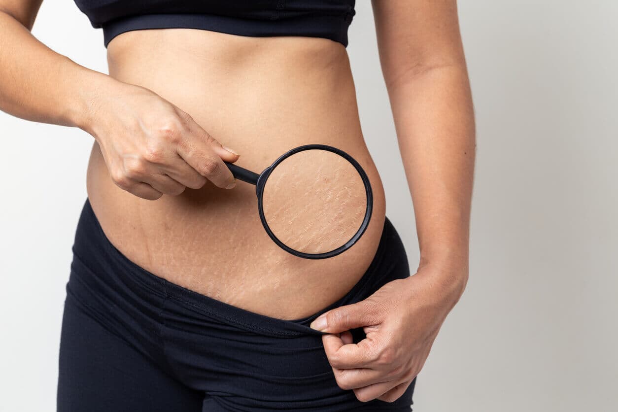 Mulher observando estrias na barriga com uma lupa