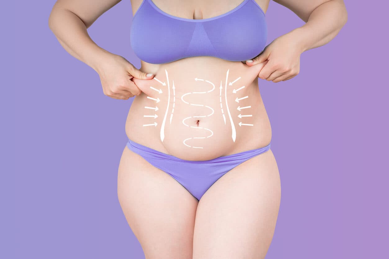 Mulher segurando excesso de pele abdominal e marcações indicando uma região de correção da diástase abdominal