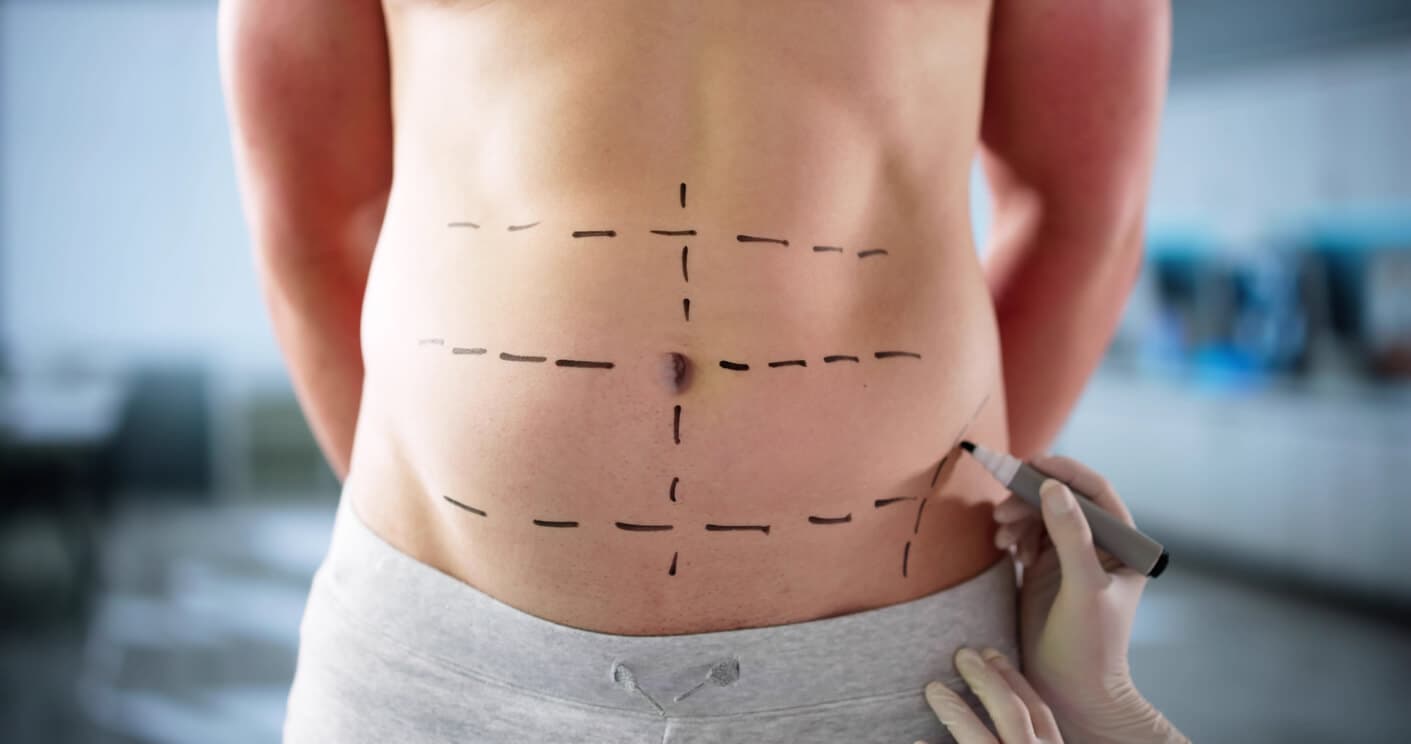 Homem com o abdômen marcado com linhas guias antes da cirurgia, ilustrando o planejamento de uma abdominoplastia masculina para remoção de excesso de pele e gordura.
