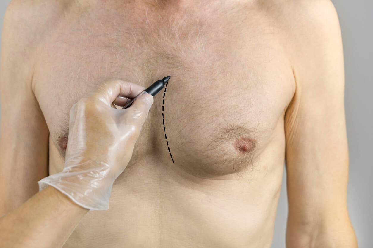 Homem com ginecomastia recebendo marcação pré-operatória no tórax para planejamento de cirurgia