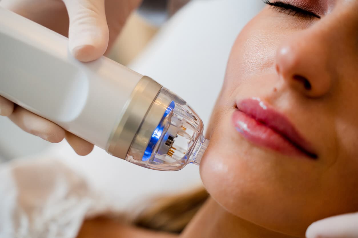 Mulher recebendo tratamento facial com aparelho de microagulhamento na região da bochecha e do queixo.