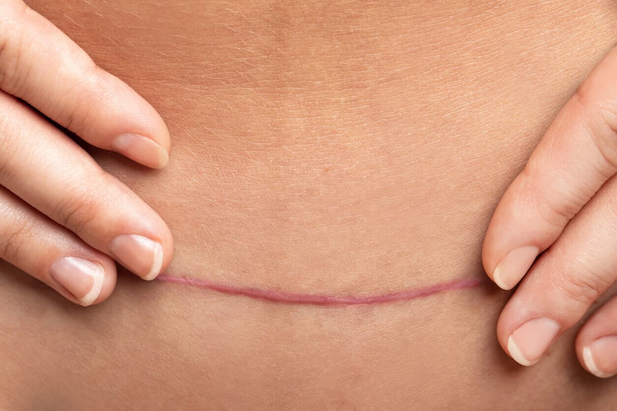 Cicatriz após cirurgia de cesariana na barriga feminina