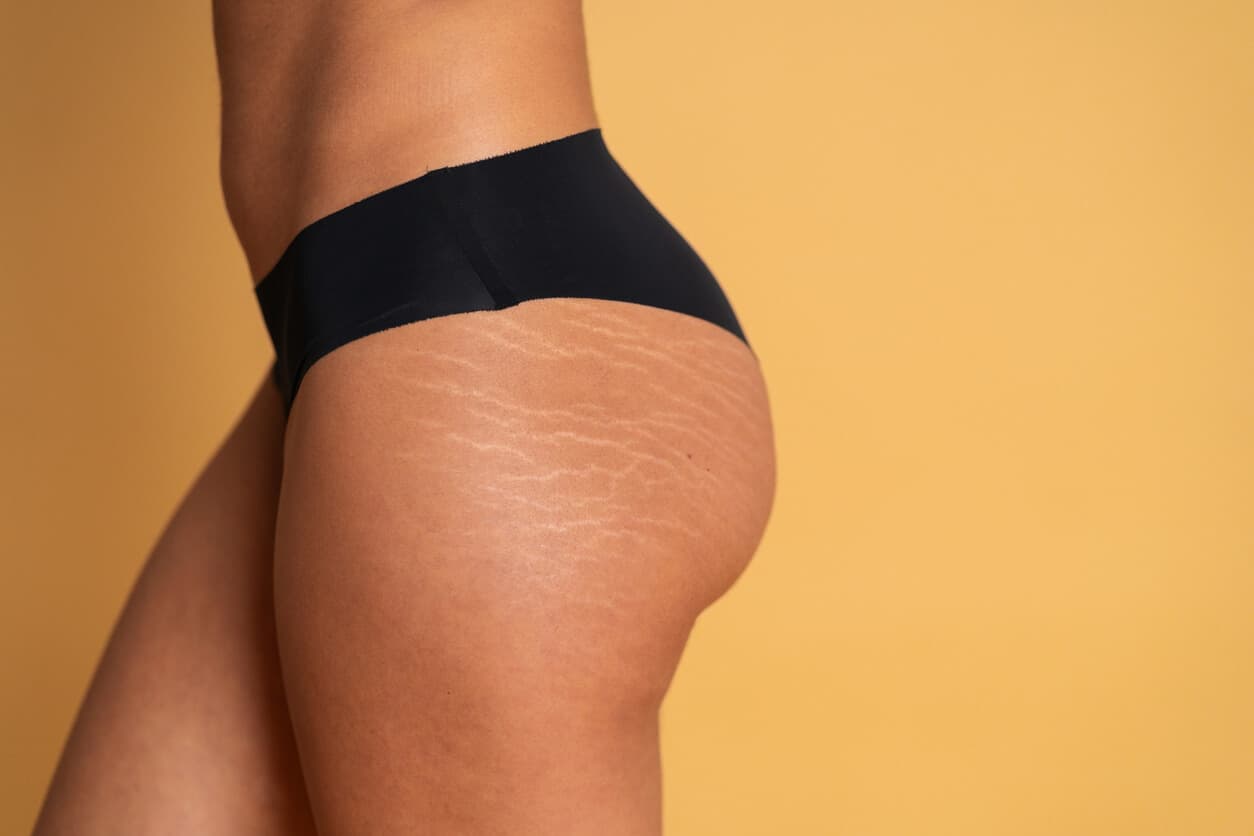 Mulher com estrias visíveis na região dos glúteos e coxas