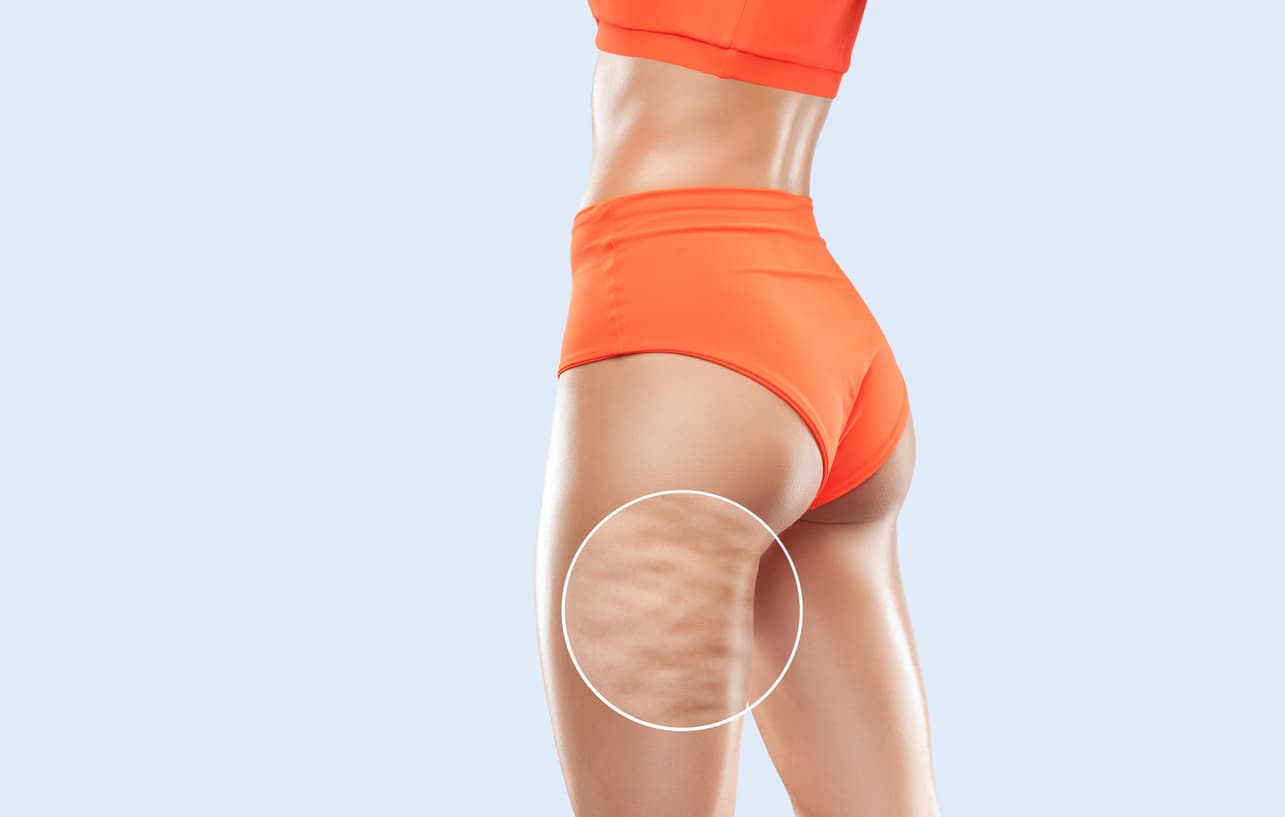 Mulher com roupa esportiva exibindo a região dos glúteos e coxas, com destaque para a aparência da celulite na pele.